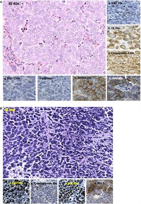 Somatostatin Receptors in Merkel-Cell Carcinoma: A Therapeutic Opportunity Using <mark class="highlighted">Somatostatin Analog</mark> Alone or in Association With Checkpoint Inhibitors Immunotherapy. A Case Report